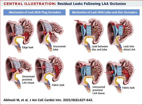 Residual Leaks Post Left Atrial Appendage Occlusion.